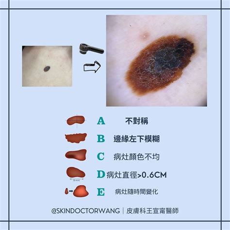 乳頭長痣|醫示警：「冒出5種痣」致死率超高！長在這部位最危。